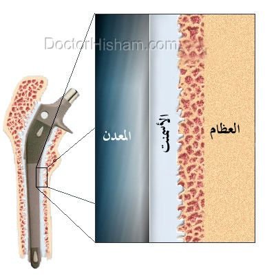 التثبيت بالأسمنت الطبي