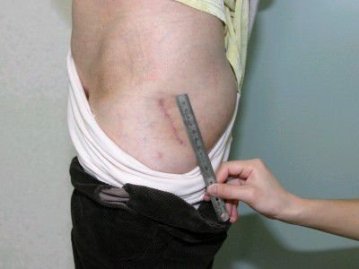 جرح المريض بعد أسبوعين من الجراحة جرح المريض بعد أسبوعين من الجراحة