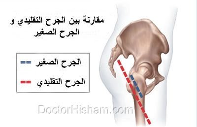 مقارنة بين الجرح التقليدي والجرح الصغير