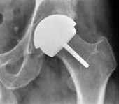 أشعة تبين المفصل بعد تركيبه