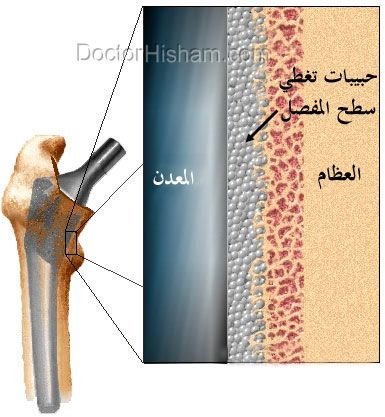 التثبيت بدون أسمنت