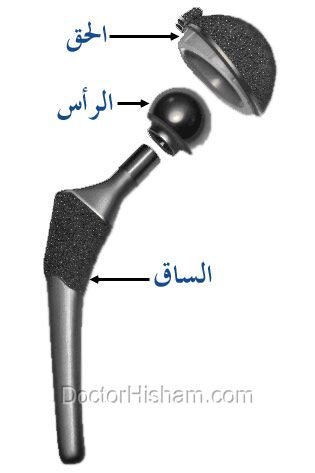 مكونات مفصل الفخذ الصناعي