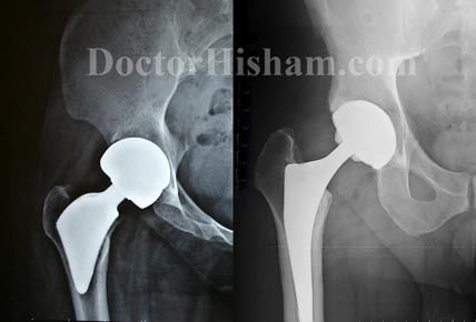 مقارنة بين مفصل الفخذ ذو الساق الصغيرة ومفصل الفخذ الصناعي التقليدي
