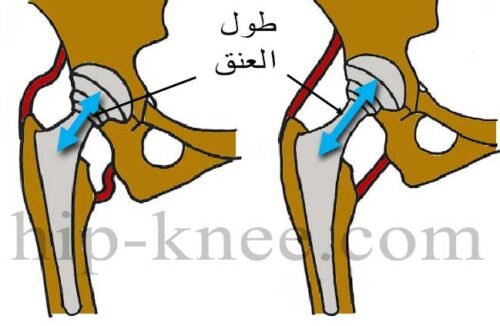 كلما زاد طول عنق المفصل الصناعي زاد شد الأنسجة المحيطه به وزاد ثبات المفصل. ولكنه يؤدي ايضا الى زيادة طول الرجل