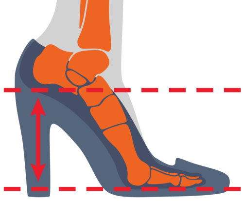 أضرار الكعب العالي