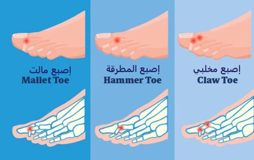 تشوهات القدم