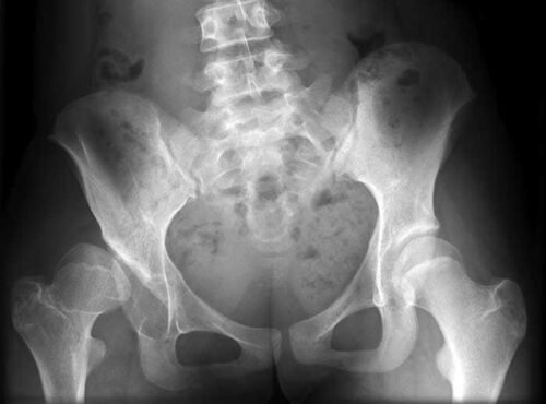 حالة خلع الفخذ الولادي