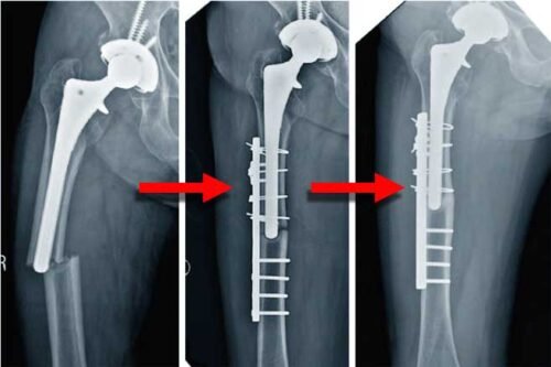 كسر عظمة الفخذ فى وجود المفصل الصناعي