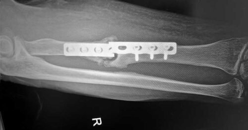 رفع شريحة و مسامير من العظام بعد كسر