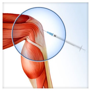 حقن البلازما الركبة