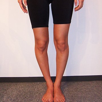 تقوس الساقين